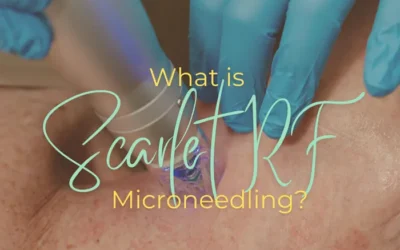 What is Scarlet RF Microneedling?