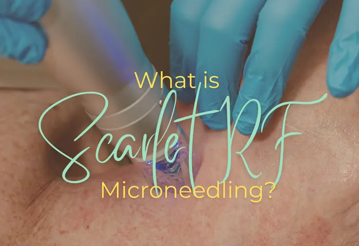 What is Scarlet RF Microneedling