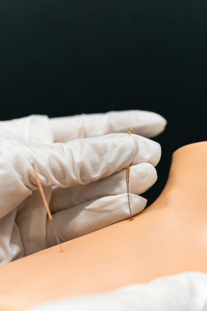 acupuncture for fascia